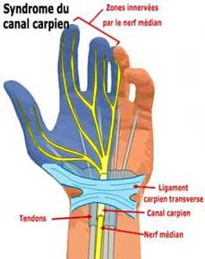 canal carpien ou tunnel carpien et étirement du poignet