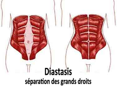 un diastase est un étirement de 5 cm de la ligne blanche