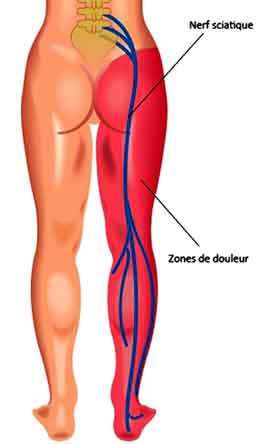 comment soigner douleur muscle pyramidal