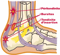 bursite tendon achille traitement
