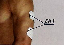 electrostimulateur sur le triceps brachial