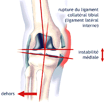 instabilité laterale du genou