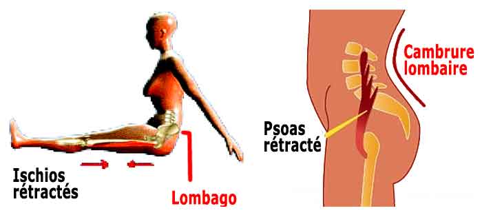 ischios jambiers et psoas raccourcis causes de cambrure et de douleur à la hanche et dans l'aine