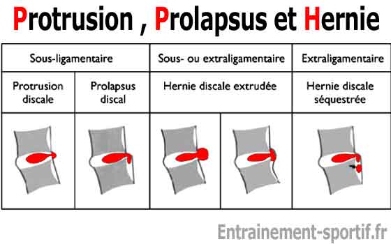 protrusion discale, prolapsus discal hernie discale extrudée et hernie discale séquestrée